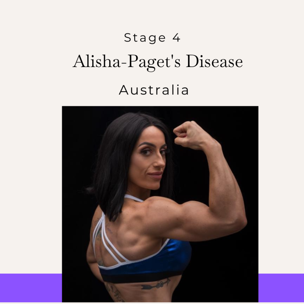 Alisha, stage 4